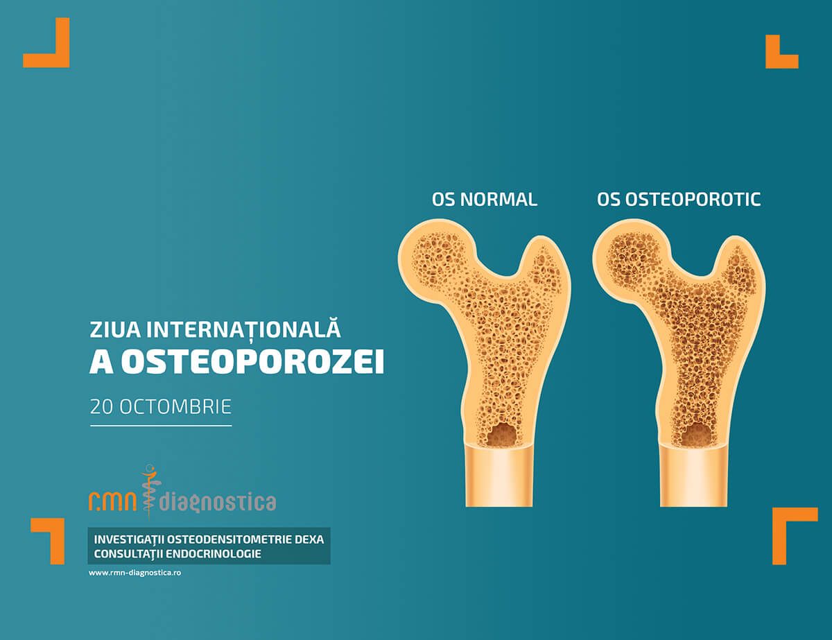 Tratamentul osteoporozei de gradul 2